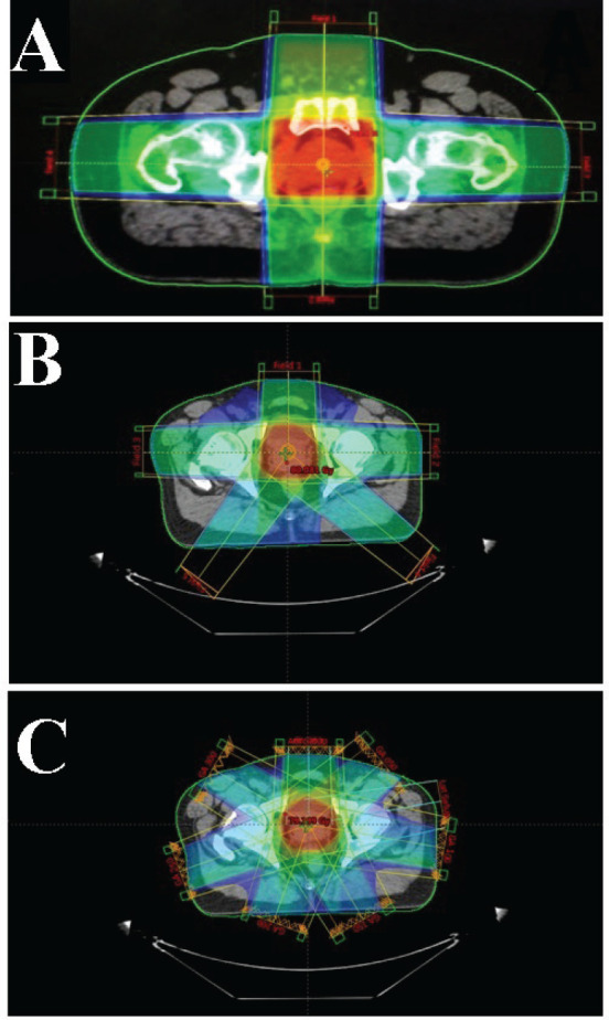 A dosimetric evaluation of intensity modulated radiotherapy and three-dimensional conformal radiotherapy for prostate cancer in Ghana.