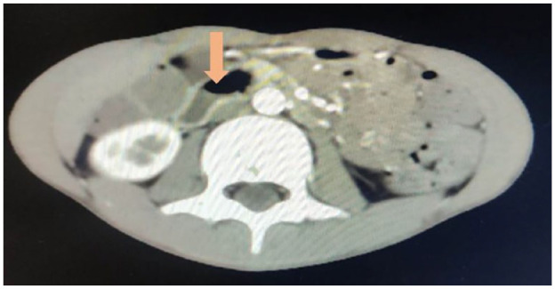 Superior Mesenteric Artery Syndrome in an 11-Year-Old Boy: A Case Report.