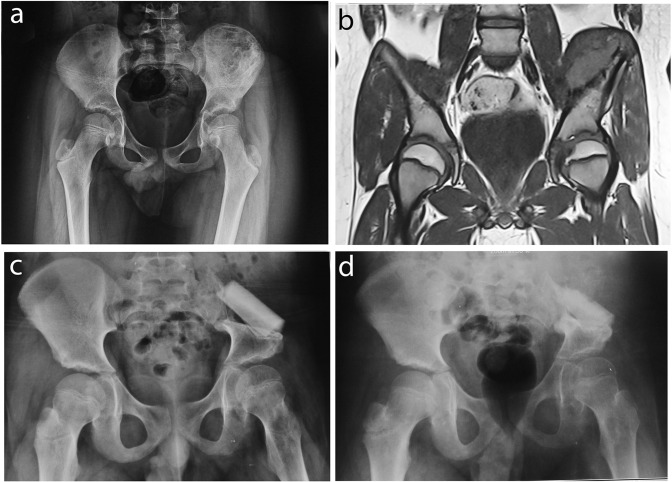 Outcomes of ilium and iliosacral Ewing's sarcoma resection reconstructed with tibial strut allograft.