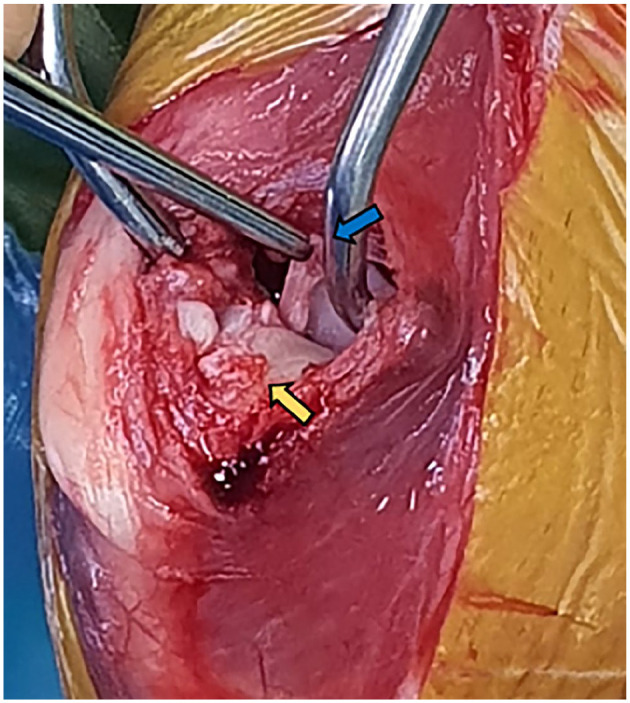 Combination of TPLO, medial and lateral augmentation techniques for the treatment of traumatic stifle luxation in a cat.