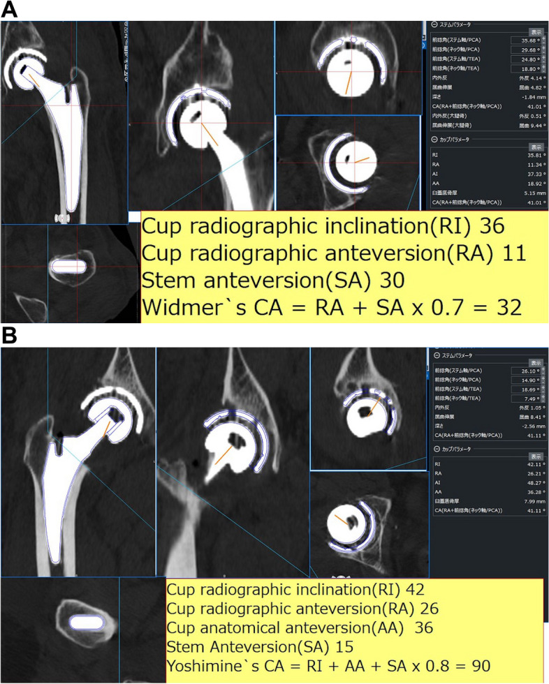 Clinical effects of combined anteversion and offset on postoperative dislocation in total hip arthroplasty.