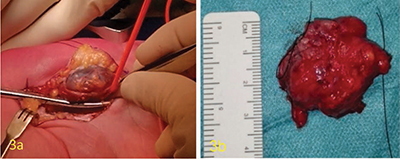 A Rare Case of Angioleiomyoma of the Palm.
