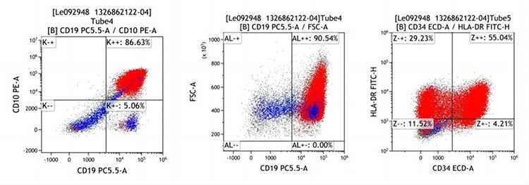 A Case of Philadelphia Chromosome-Positive Acute Lymphoblastic Leukemia with Coexistence of the <i>JAK2V617F</i> Clone