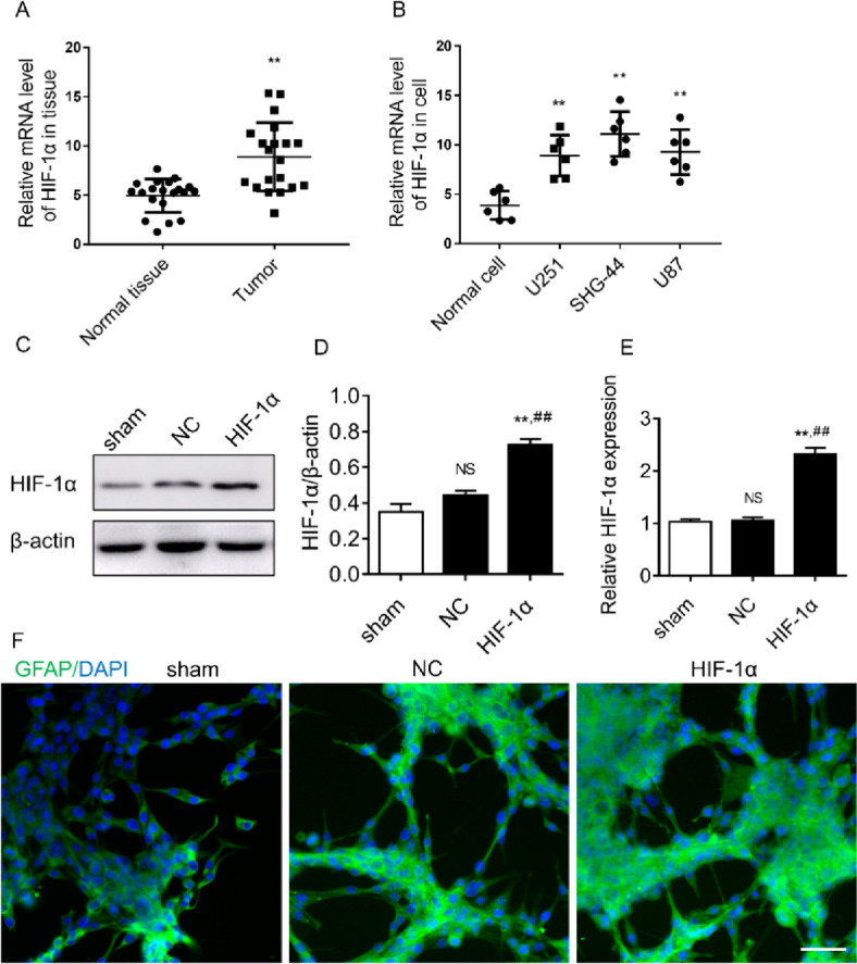 HIF-1α facilitates glioma proliferation and invasion by activating pyroptosis signaling axis.