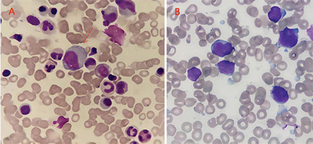 A Case of Philadelphia Chromosome-Positive Acute Lymphoblastic Leukemia with Coexistence of the <i>JAK2V617F</i> Clone