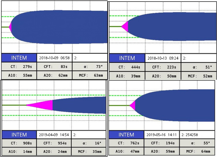 Assessment of the phenotypic severity of hemophilia A: using rotational thromboelastometry (ROTEM) and APTT-clot waveform analysis.