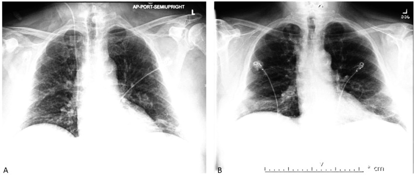 Diagnosis and Management of Daptomycin-Induced Acute Eosinophilic Pneumonia: A Case Report.