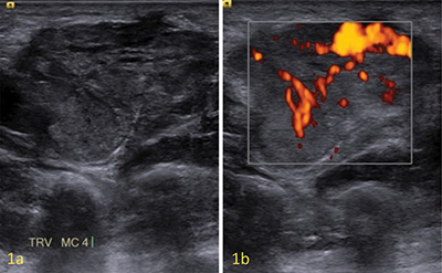 A Rare Case of Angioleiomyoma of the Palm.