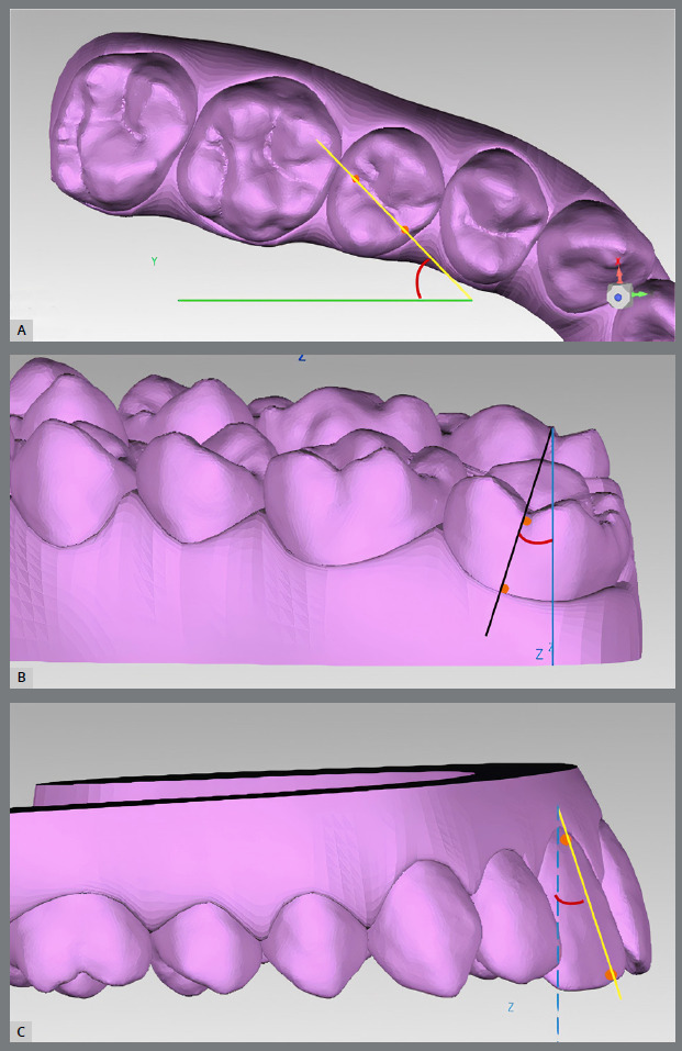 Accuracy of Invisalign® aligners in adult patients: a retrospective study of angular tooth movements.