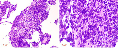A Case of Philadelphia Chromosome-Positive Acute Lymphoblastic Leukemia with Coexistence of the <i>JAK2V617F</i> Clone