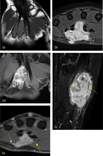 A Rare Case of Angioleiomyoma of the Palm.