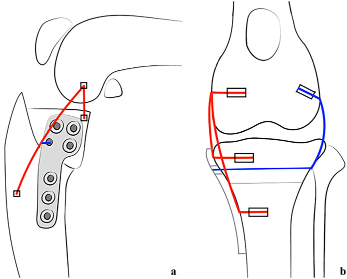 Combination of TPLO, medial and lateral augmentation techniques for the treatment of traumatic stifle luxation in a cat.