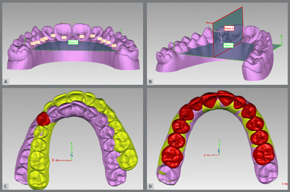 Accuracy of Invisalign® aligners in adult patients: a retrospective study of angular tooth movements.
