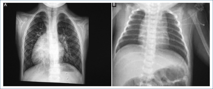 [Diagnosis and treatment in a series of patients with cardiac corrected transposition of the great arteries (double discordance)].