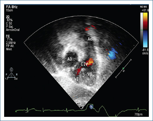 [Diagnosis and treatment in a series of patients with cardiac corrected transposition of the great arteries (double discordance)].