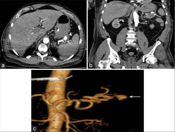Unusual causes of gastrointestinal bleeding in the intensive care unit through the radiology lens.