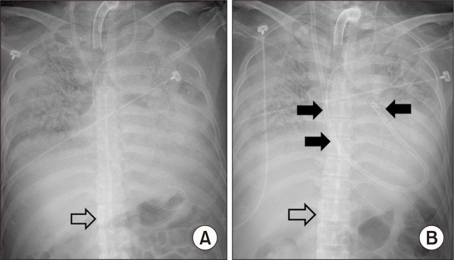 Percutaneous OxyRVAD in a Patient with Severe Respiratory Failure and Right Heart Failure: A Case Report.