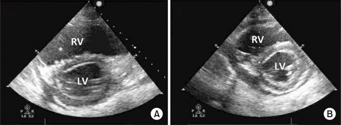 Percutaneous OxyRVAD in a Patient with Severe Respiratory Failure and Right Heart Failure: A Case Report.