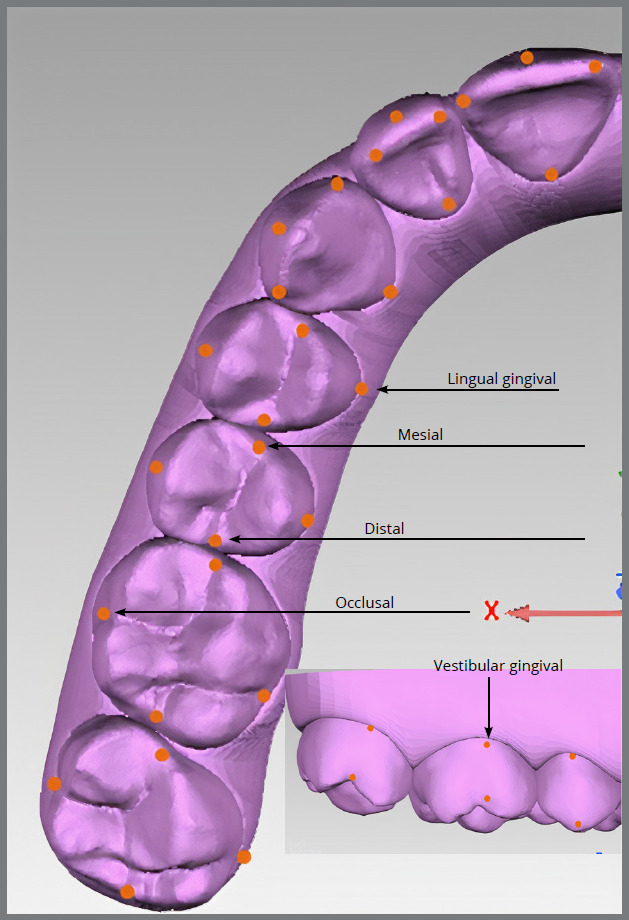 Accuracy of Invisalign® aligners in adult patients: a retrospective study of angular tooth movements.