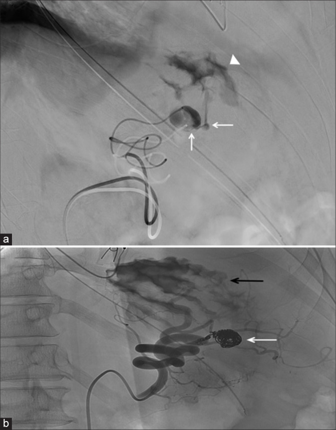 Unusual causes of gastrointestinal bleeding in the intensive care unit through the radiology lens.
