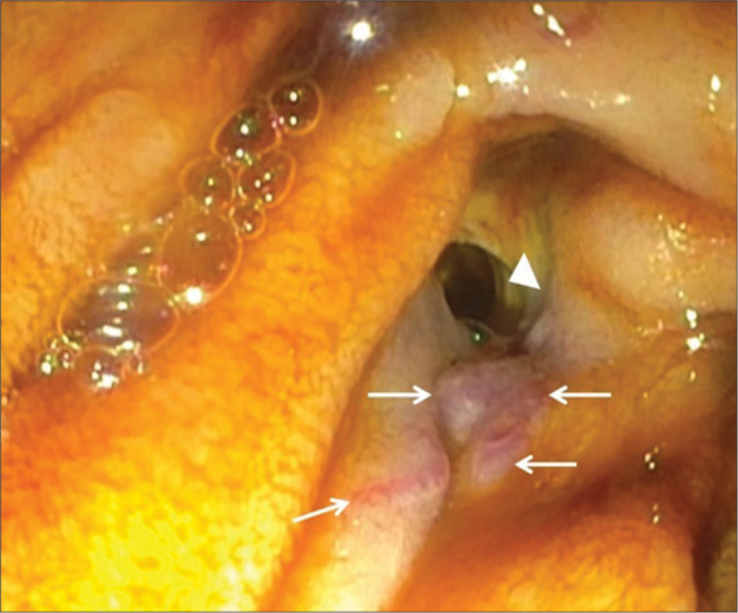 Unusual causes of gastrointestinal bleeding in the intensive care unit through the radiology lens.