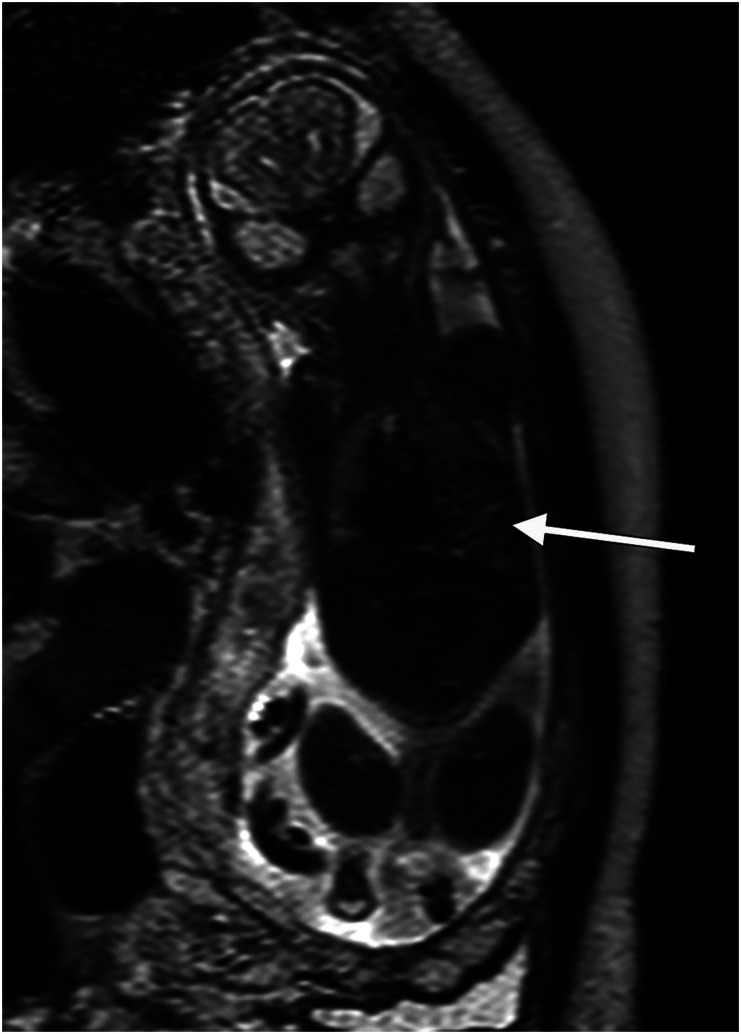 Magnetic resonance imaging in the second trimester as a complement to ultrasound for diagnosis of fetal anomalies.