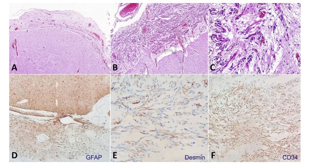 Trisomy 13 with unusual histological features typically described in Beckwith-Wiedemann Spectrum.