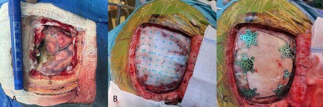Hemopatch<sup>®</sup> as a primary dural sealant in cranial neurosurgery: Technical note and a retrospective study.