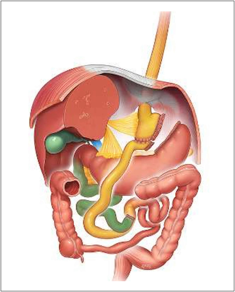 Effects of bariatric surgery on renal function: a retrospective cohort study comparing one-year outcomes between one-anastomosis gastric bypass and Roux-en-Y gastric bypass.