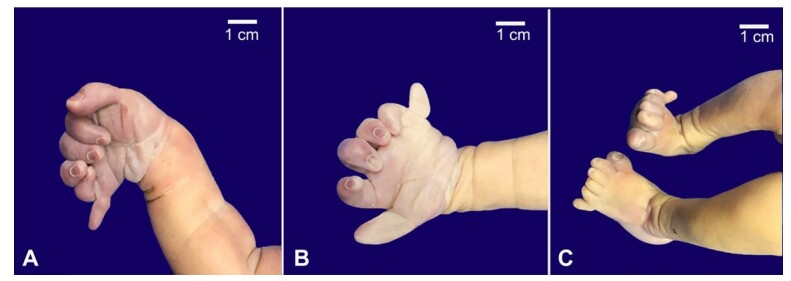 Trisomy 13 with unusual histological features typically described in Beckwith-Wiedemann Spectrum.