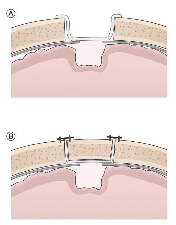 Normative parameters of the Evans Index using Computer Tomography in the Saudi population.