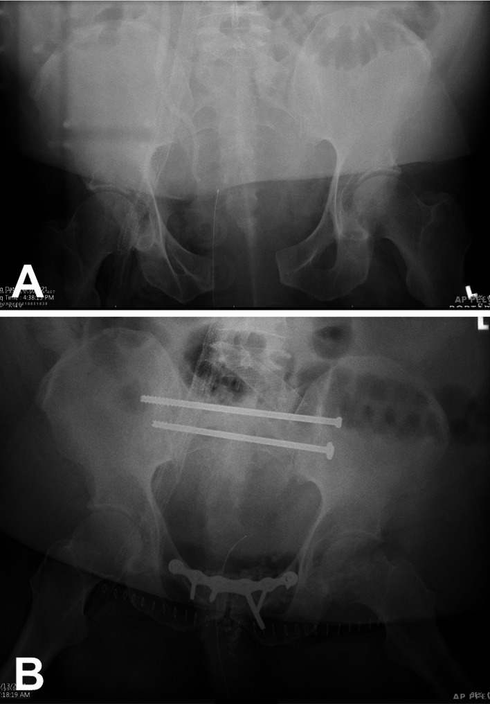 The pathophysiology of pelvic ring injuries: a review.