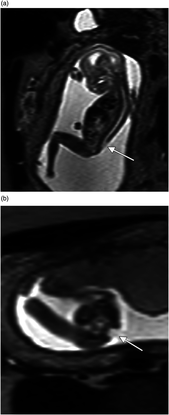 Magnetic resonance imaging in the second trimester as a complement to ultrasound for diagnosis of fetal anomalies.