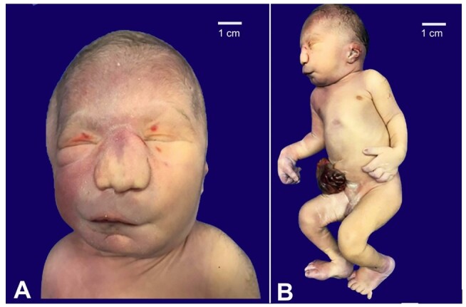 Trisomy 13 with unusual histological features typically described in Beckwith-Wiedemann Spectrum.