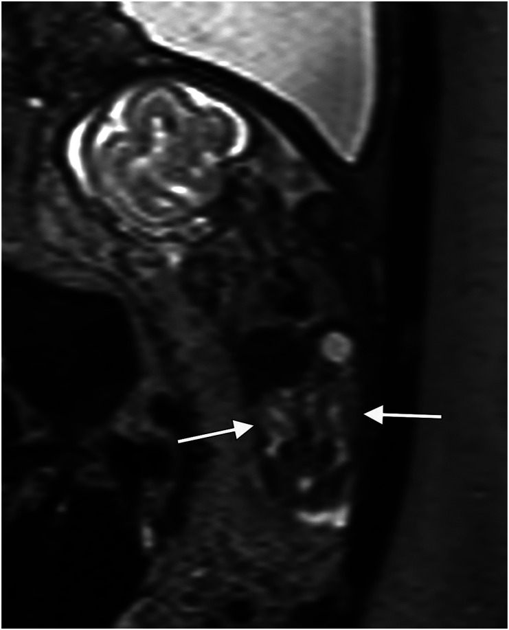 Magnetic resonance imaging in the second trimester as a complement to ultrasound for diagnosis of fetal anomalies.
