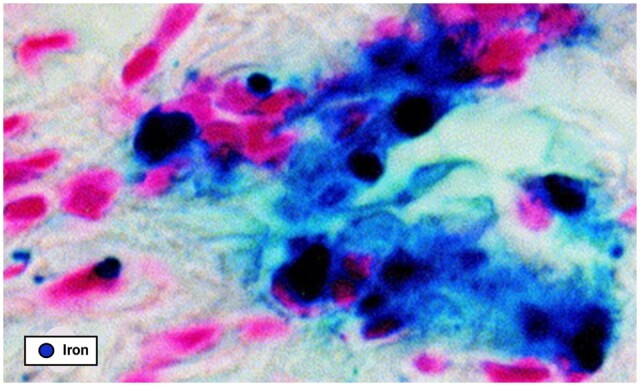 Endometriosis: from iron and macrophages to exosomes. Is the sky clearing?