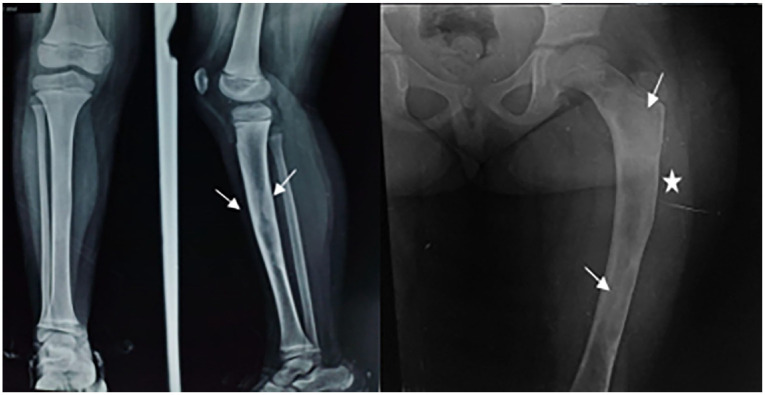 Fibrous Dysplasia Polyostotic: When Radiology Clarifies the Diagnosis.