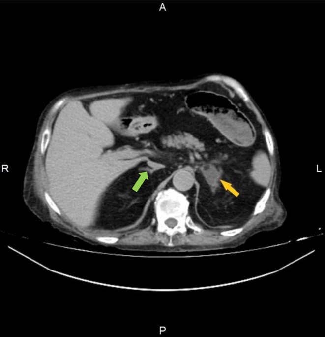 Cushing's disease presenting with recurrent abscesses followed by post-remission hyperthyroidism.