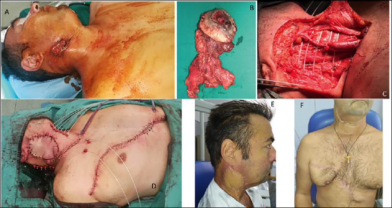 Interventional radiotherapy (brachytherapy) for re-irradiation of recurrent head and neck malignancies: oncologic outcomes and morbidity.