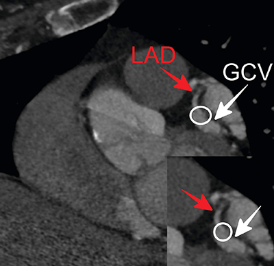 Detection of Coronary Artery Fistula between the LAD and the Great Cardiac Vein on Coronary CT Angiography.