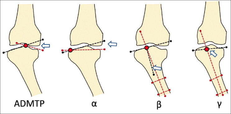 Change in angle of depressed medial tibial plateau following extra-articular mechanical realignment surgery in children with Blount's disease who presented late for treatment.