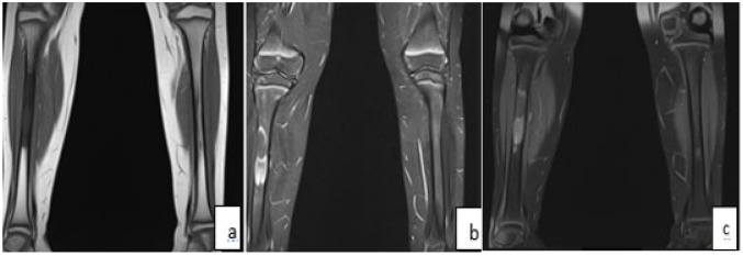 Fibrous Dysplasia Polyostotic: When Radiology Clarifies the Diagnosis.
