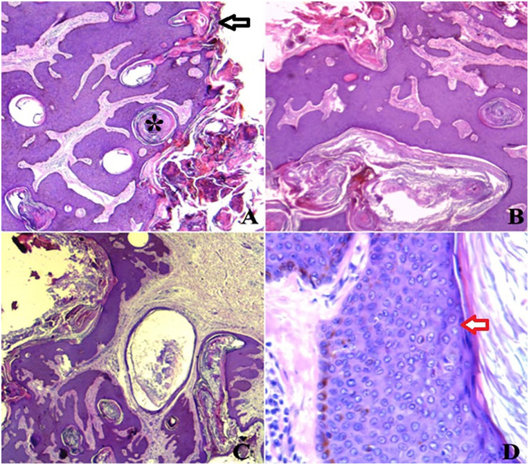 Seborrheic Keratosis: Report of a Rare Presentation and Reminder of the Current Knowledge of the Problem.