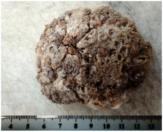 Seborrheic Keratosis: Report of a Rare Presentation and Reminder of the Current Knowledge of the Problem.
