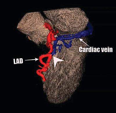 Detection of Coronary Artery Fistula between the LAD and the Great Cardiac Vein on Coronary CT Angiography.