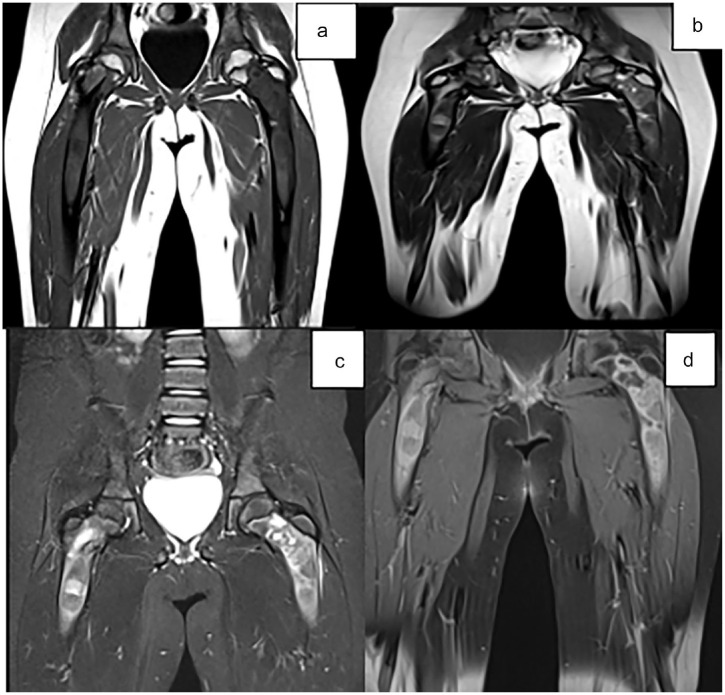 Fibrous Dysplasia Polyostotic: When Radiology Clarifies the Diagnosis.