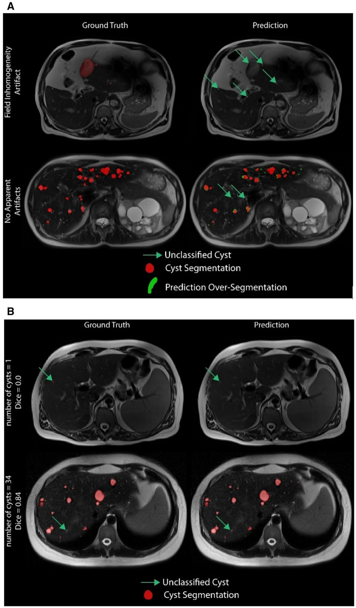 Deep learning-based liver cyst segmentation in MRI for autosomal dominant polycystic kidney disease.
