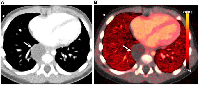 Photon counting detector computed tomography in pediatric cardiothoracic CT imaging.