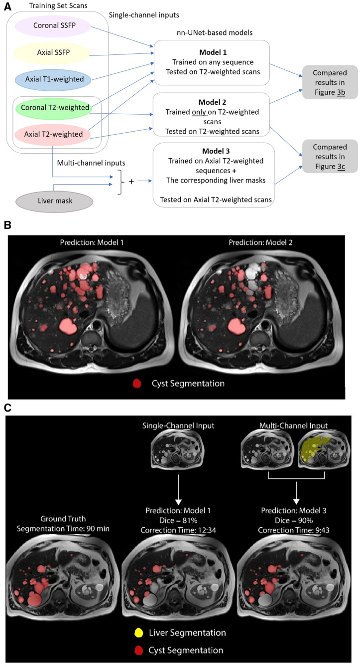 Deep learning-based liver cyst segmentation in MRI for autosomal dominant polycystic kidney disease.