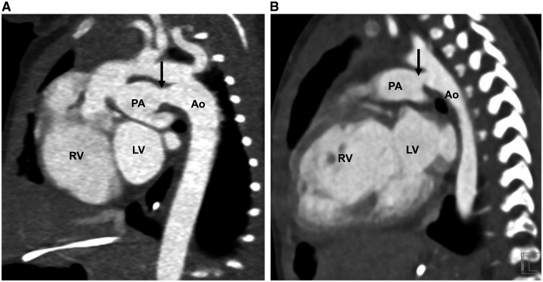 Photon counting detector computed tomography in pediatric cardiothoracic CT imaging.